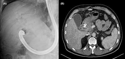 Utility of interventional endoscopic ultrasound in pancreatic cancer